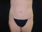 Tummy Tuck by Dr. Butler