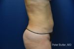 Liposuction by Dr. Butler