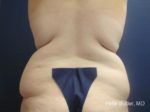 Liposuction by Dr. Butler