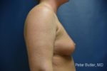 Breast Augmentation by Dr. Butler