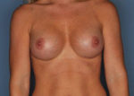 Breast Augmentation by Dr. Patterson