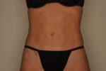 Liposuction by Dr Patterson