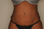 Liposuction by Dr Patterson