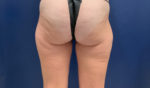 Liposuction by Dr. Leveque