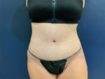 Tummy Tuck by Dr. Leveque