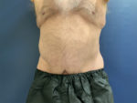 Tummy Tuck by Dr. Patterson