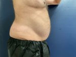 Tummy Tuck by Dr. Patterson
