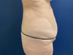 Liposuction by Dr. Leveque