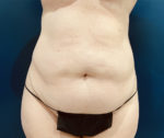 Tummy Tuck by Dr. Leveque