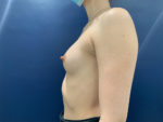 Breast Augmentation by Dr. Patterson