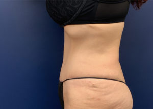 Tummy Tuck by Dr. Butler