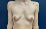 Breast Augmentation by Dr. Leveque