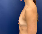 Breast Augmentation by Dr. Butler