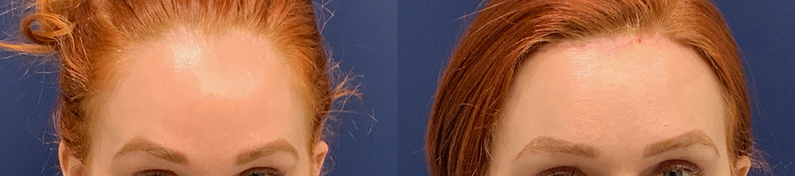 Brow Lift Before and After Photo by Dr. Leveque of Gulf Coast Plastic Surgery in Pensacola, FL