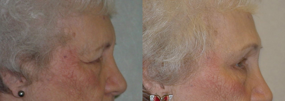 Brow Lift Before and After Photo by Dr. Leveque of Gulf Coast Plastic Surgery in Pensacola, FL