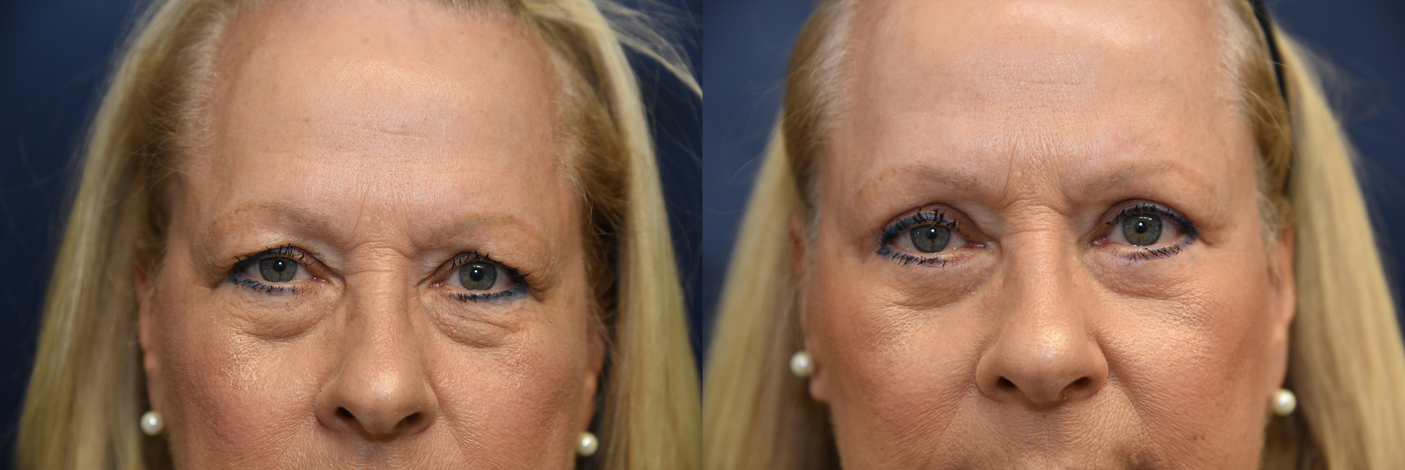 Facelift Before and After Photo by Dr. Leveque of Gulf Coast Plastic Surgery in Pensacola, FL