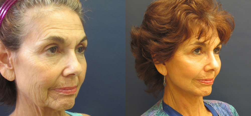 Facelift Before and After Photo by Dr. Leveque of Gulf Coast Plastic Surgery in Pensacola, FL