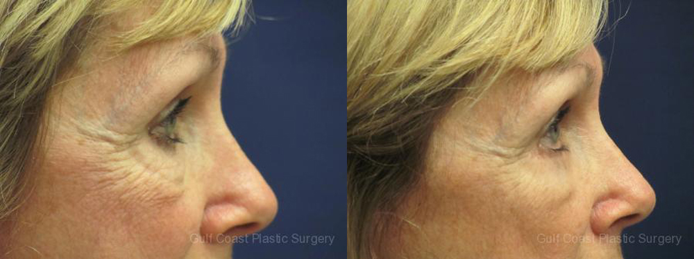Lower Eyelid Lift Before and After Photo by Dr. Leveque of Gulf Coast Plastic Surgery in Pensacola, FL