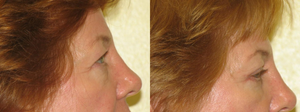 Lower Eyelid Lift Before and After Photo by Dr. Leveque of Gulf Coast Plastic Surgery in Pensacola, FL