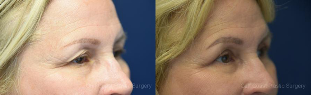Upper Eyelid Lift Before and After Photo by Dr. Leveque of Gulf Coast Plastic Surgery in Pensacola, FL