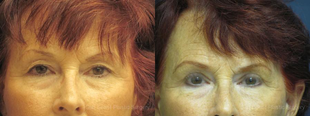 Upper Eyelid Lift Before and After Photo by Dr. Leveque of Gulf Coast Plastic Surgery in Pensacola, FL