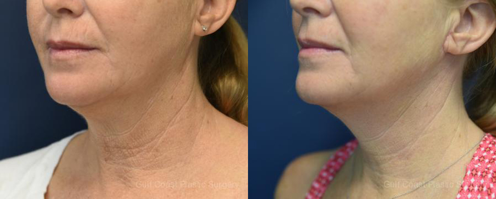 Neck Lift Before and After Photo by Dr. Leveque of Gulf Coast Plastic Surgery in Pensacola, FL