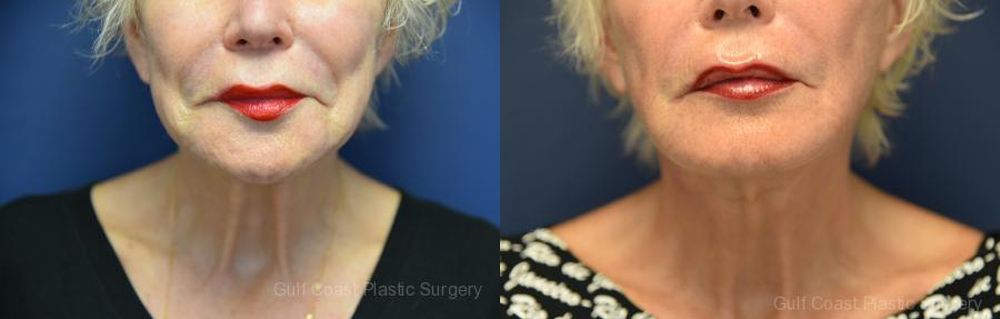 Neck Lift Before and After Photo by Dr. Leveque of Gulf Coast Plastic Surgery in Pensacola, FL