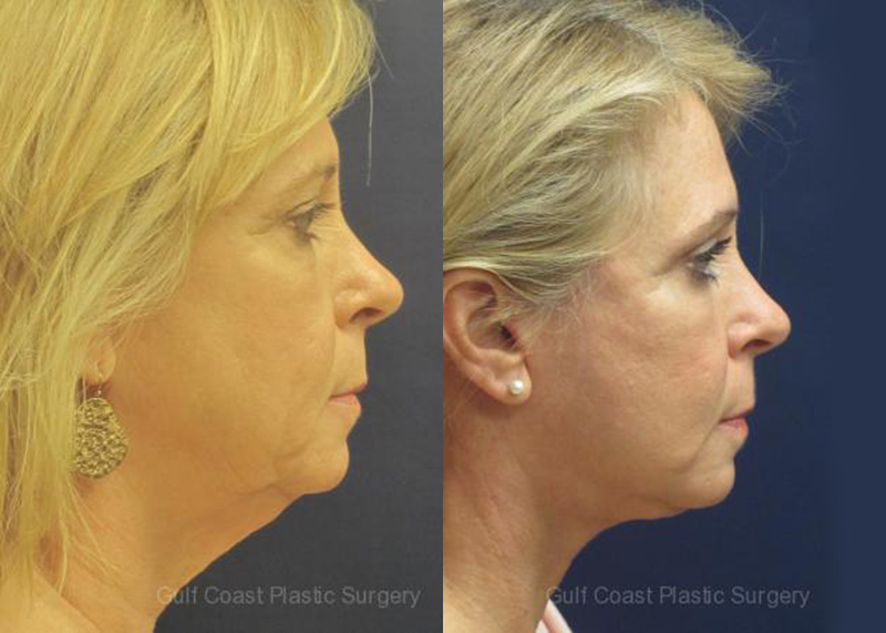 Fat Transfer to Face Before and After Photo by Dr. Leveque of Gulf Coast Plastic Surgery in Pensacola, FL