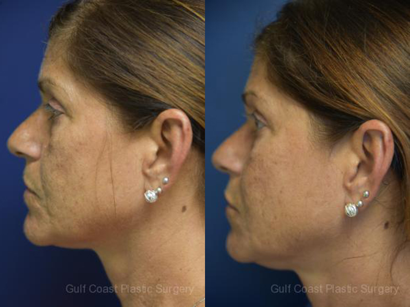 Fat Transfer to Face Before and After Photo by Dr. Leveque of Gulf Coast Plastic Surgery in Pensacola, FL