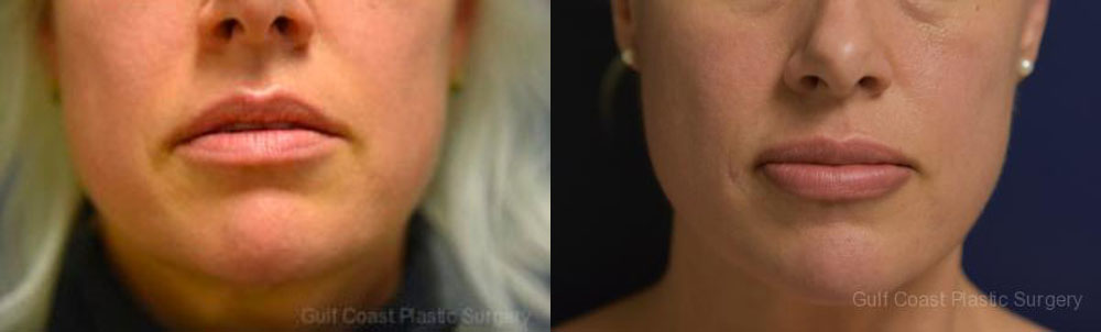 Lip Augmentation Before and After Photo by Dr. Leveque of Gulf Coast Plastic Surgery in Pensacola, FL