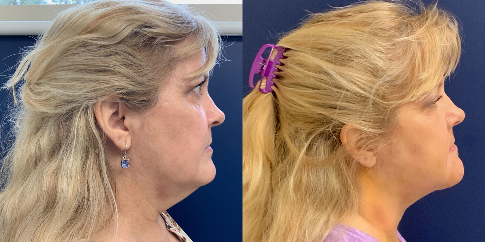 Liposuction of Neck Before and After Photo by Dr. Leveque of Gulf Coast Plastic Surgery in Pensacola, FL