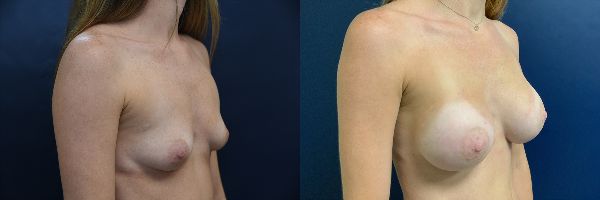 Breast Augmentation Before and After Photo by Dr. Leveque of Gulf Coast Plastic Surgery in Pensacola, FL