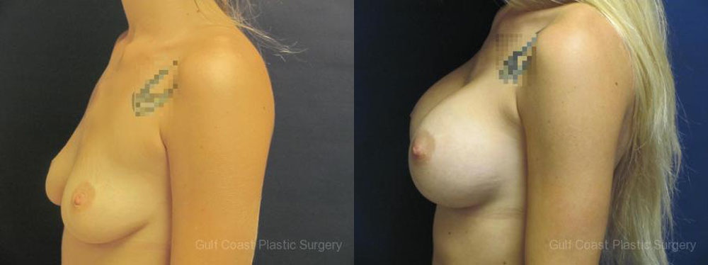 Breast Augmentation Before and After Photo by Dr. Leveque of Gulf Coast Plastic Surgery in Pensacola, FL