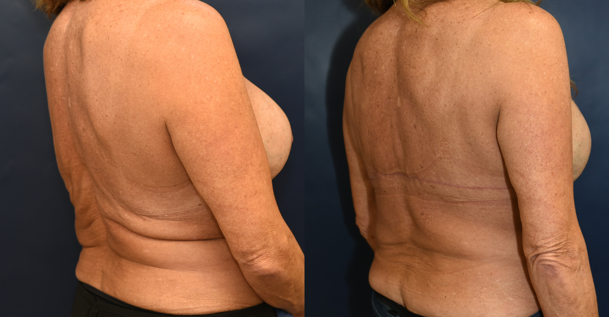 Back Lift Before and After Photo by Dr. Butler in Pensacola Florida