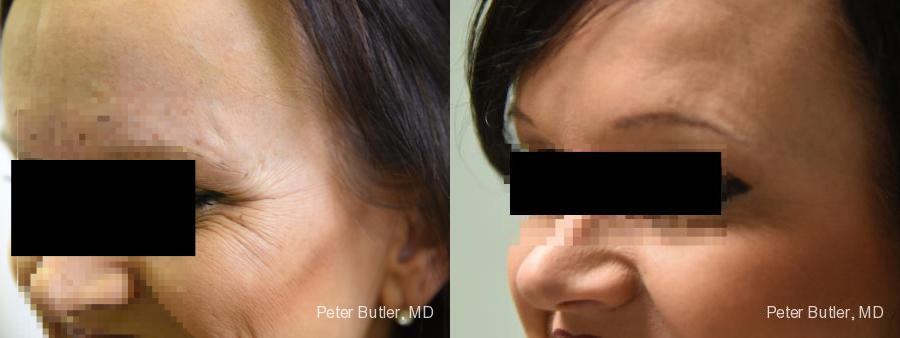 Botox Before and After Photo by Dr. Butler in Pensacola Florida