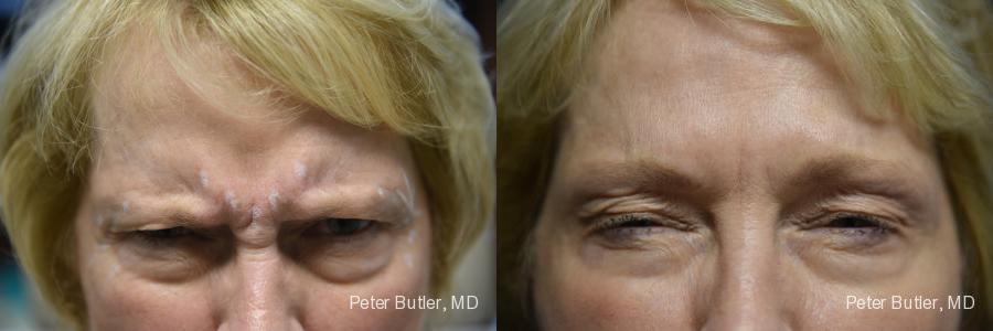 Botox Before and After Photo by Dr. Butler in Pensacola Florida