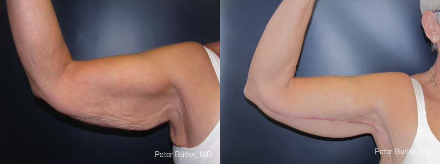 Brachioplasty Before and After Photo by Dr. Butler in Pensacola Florida
