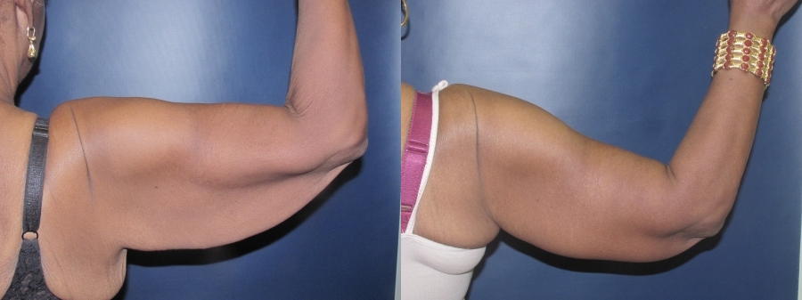 Brachioplasty Before and After Photo by Dr. Butler in Pensacola Florida