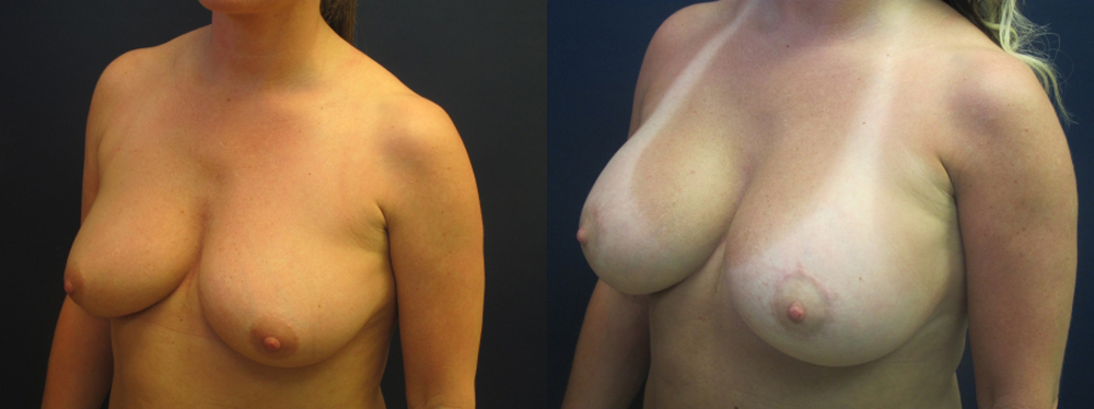 Breast Augmentation with Lift Before and After Photo by Dr. Leveque of Gulf Coast Plastic Surgery in Pensacola, FL