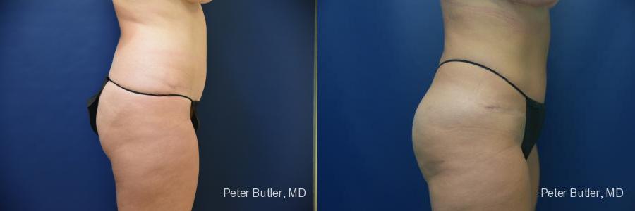 Brazilian Butt Lift Before and After Photo by Dr. Butler in Pensacola Florida