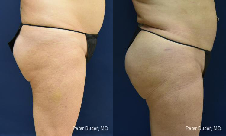 Brazilian Butt Lift Before and After Photo by Dr. Butler in Pensacola Florida