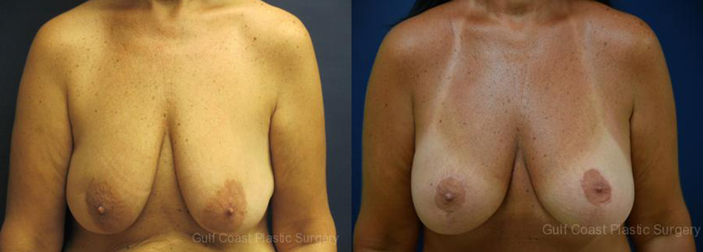 Breast Reconstruction Before and After Photo by Dr. Leveque of Gulf Coast Plastic Surgery in Pensacola, FL