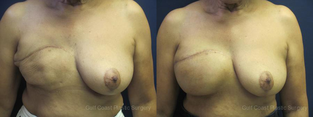 Breast Reconstruction Before and After Photo by Dr. Leveque of Gulf Coast Plastic Surgery in Pensacola, FL