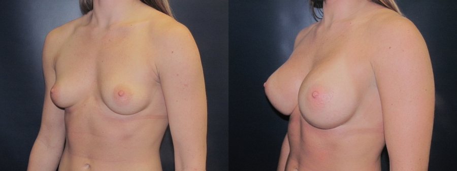 Breast Augmentation Before and After Photo by Dr. Butler in Pensacola Florida