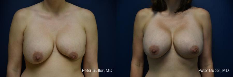 Breast Augmentation with Fat Before and After Photo by Dr. Butler in Pensacola Florida