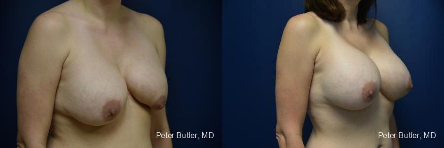 Breast Augmentation with Fat Before and After Photo by Dr. Butler in Pensacola Florida