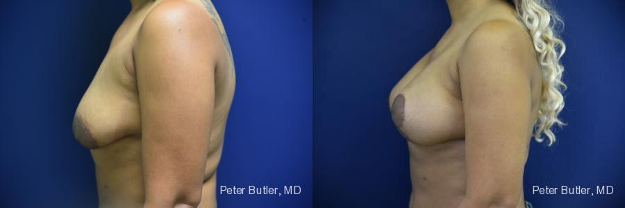 Breast Augmentation with Lift Before and After Photo by Dr. Butler in Pensacola Florida