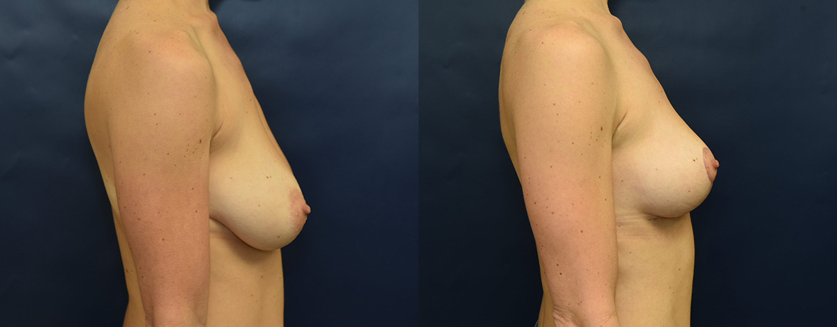 Breast Augmentation with Lift Before and After Photo by Dr. Butler in Pensacola Florida