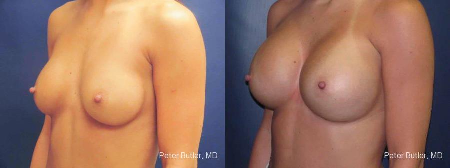 Breast Implant Exchange Before and After Photo by Dr. Butler in Pensacola Florida