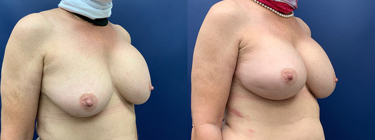Breast Implant Exchange Before and After Photo by Dr. Butler in Pensacola Florida